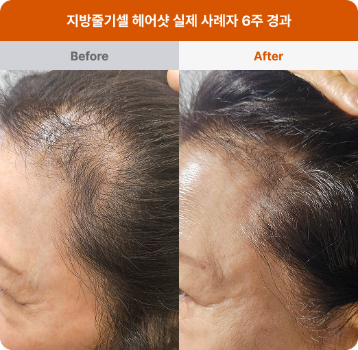 지방줄기셀 헤어샷 before&after 이미지