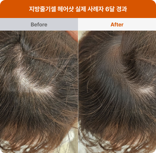 지방줄기셀 헤어샷 before&after 이미지