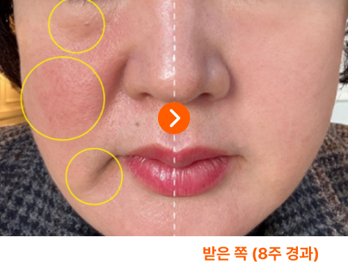 안 받은 쪽, 받은 쪽 (8주 경과)